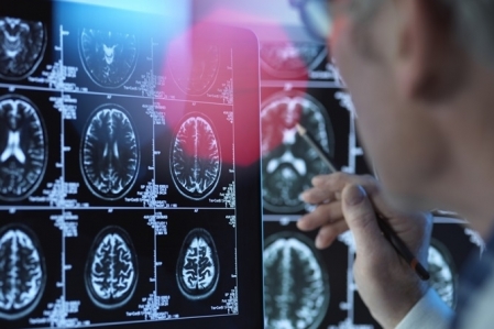 Cientistas desenvolvem neurnios artificiais para tratamento de Alzheimer